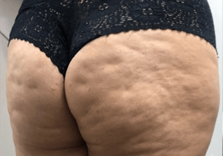 Bumbum-antes.png