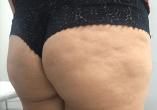 Bumbum-depois.png